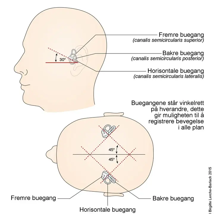 BPPV